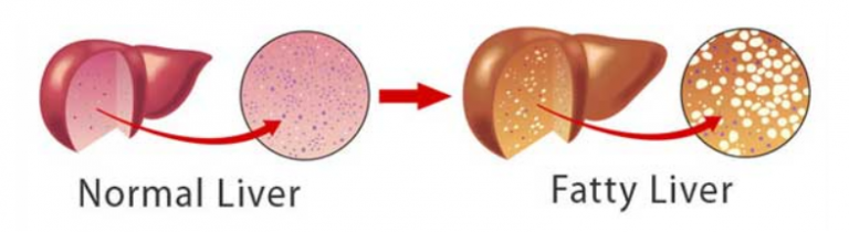 fatty liver vs normal liver