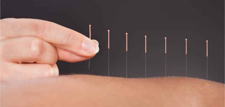 Read more about the article THE POWER OF ACUPUNCTURE